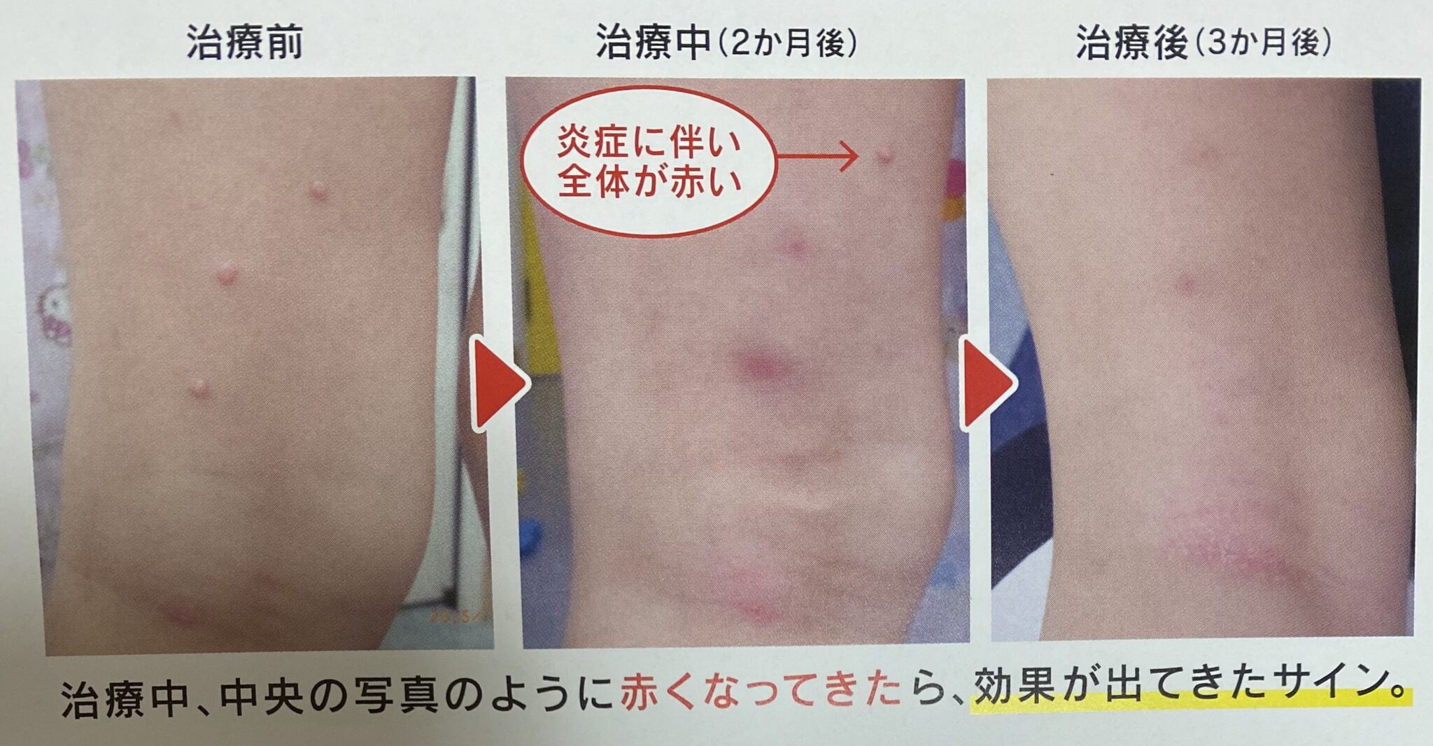 伝染性軟属腫を予防するにはどうすればよいですか?
